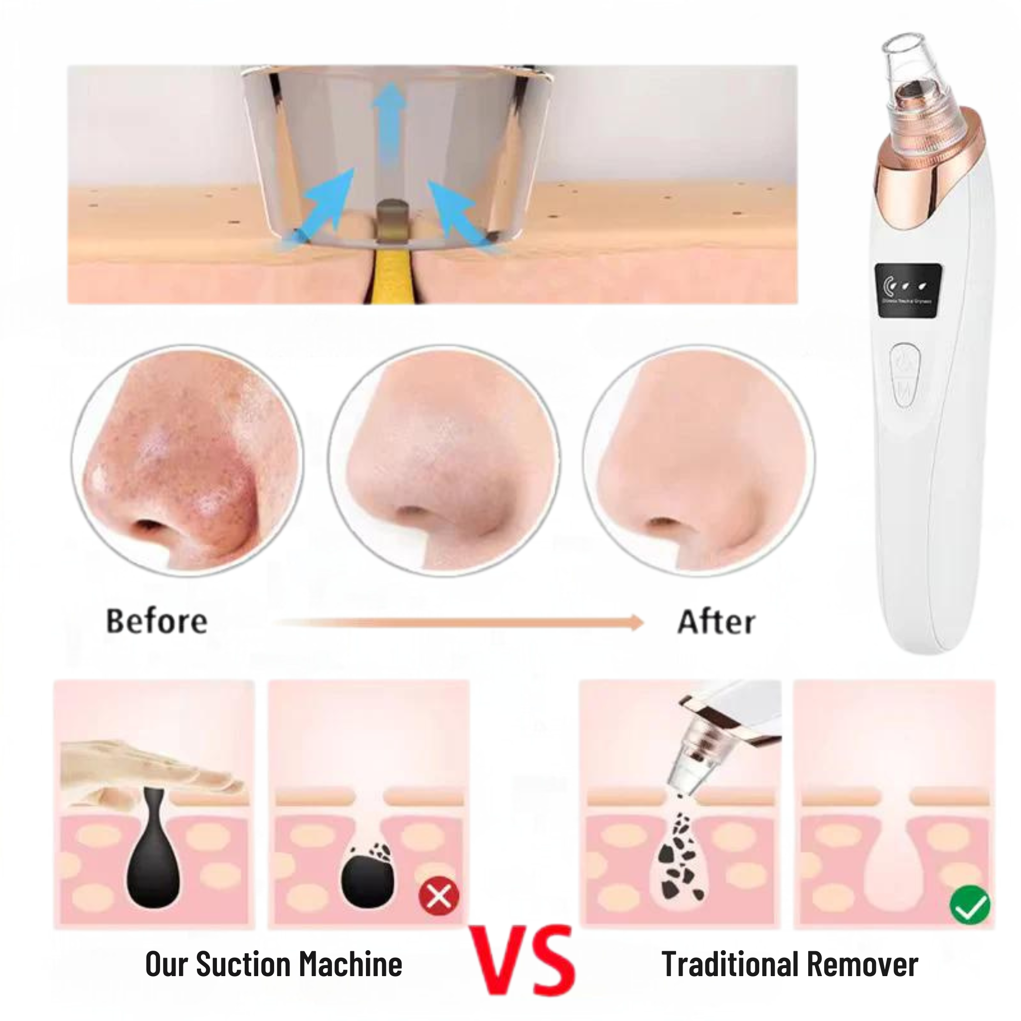 5-in-1 Electric Blackhead Remover & Facial Pore Cleaner